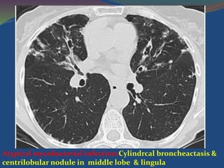 Atypical mycobacterial infection:Cylindrcal broncheactasis &
centrilobular nodule in middle lobe & lingula
 