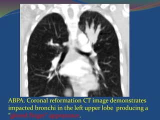 ABPA. Coronal reformation CT image demonstrates
impacted bronchi in the left upper lobe producing a
“gloved finger” appearance.
 