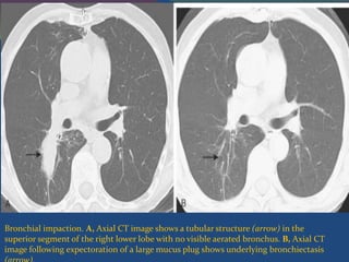 Bronchial impaction. A, Axial CT image shows a tubular structure (arrow) in the
superior segment of the right lower lobe with no visible aerated bronchus. B, Axial CT
image following expectoration of a large mucus plug shows underlying bronchiectasis
 