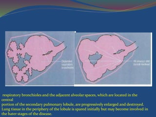 respiratory bronchioles and the adjacent alveolar spaces, which are located in the
central
portion of the secondary pulmonary lobule, are progressively enlarged and destroyed.
Lung tissue in the periphery of the lobule is spared initially but may become involved in
the hater stages of the disease.
 