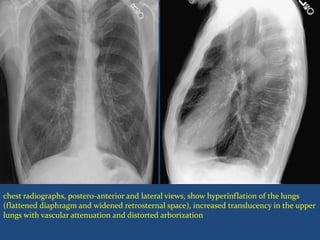 chest radiographs, postero-anterior and lateral views, show hyperinflation of the lungs
(flattened diaphragm and widened retrosternal space), increased translucency in the upper
lungs with vascular attenuation and distorted arborization
 