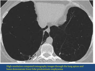 High-resolution computed tomography images through the lung apices and
bases demonstrate lower lobe predominate emphysema
 