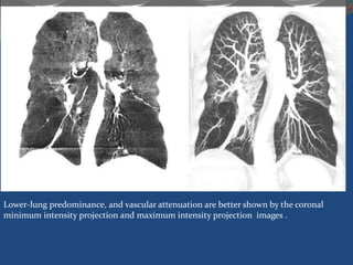 Lower-lung predominance, and vascular attenuation are better shown by the coronal
minimum intensity projection and maximum intensity projection images .
 