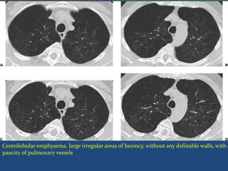Centrilobular emphysema. large irregular areas of lucency, without any definable walls, with a
paucity of pulmonary vessels
 