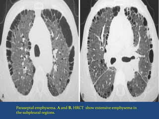 Paraseptal emphysema. A and B, HRCT show extensive emphysema in
the subpleural regions.
 