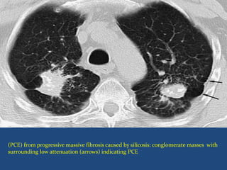 (PCE) from progressive massive fibrosis caused by silicosis: conglomerate masses with
surrounding low attenuation (arrows) indicating PCE
 