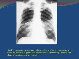‘Both upper zones are occupied by large bullae which are compressing upper
lobes. No evidence of generalised emphysema or air trapping. The level and
shape of the diaphragm are normal
 