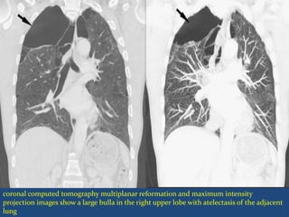 coronal computed tomography multiplanar reformation and maximum intensity
projection images show a large bulla in the right upper lobe with atelectasis of the adjacent
lung
 