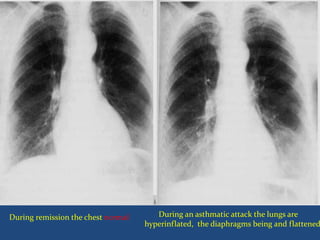 During an asthmatic attack the lungs are
hyperinflated, the diaphragms being and flattened
During remission the chest normal
 