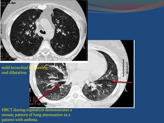 mild bronchial thickening
and dilatation
HRCT during expiration demonstrates a
mosaic pattern of lung attenuation in a
patient with asthma.
 