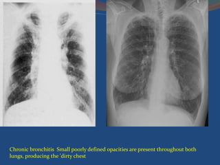 Chronic bronchitis Small poorly defined opacities are present throughout both
lungs, producing the 'dirty chest
 