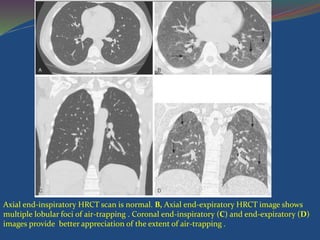 Axial end-inspiratory HRCT scan is normal. B, Axial end-expiratory HRCT image shows
multiple lobular foci of air-trapping . Coronal end-inspiratory (C) and end-expiratory (D)
images provide better appreciation of the extent of air-trapping .
 