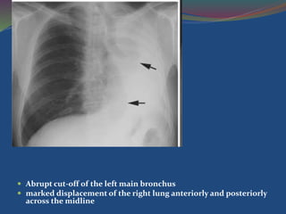  Abrupt cut-off of the left main bronchus
 marked displacement of the right lung anteriorly and posteriorly
across the midline
 