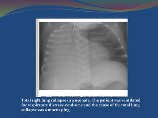 Total right lung collapse in a neonate. The patient was ventilated
for respiratory distress syndrome and the cause of the total lung
collapse was a mucus plug
 