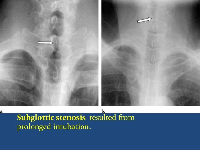 Air way disease