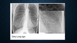Presentation about the Airway Diseases Radiology | PPTX