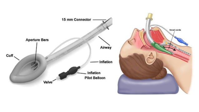 Airway equipments for Anaesthesia | PDF