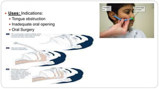 Uses: Indications:
 Tongue obstruction
 Inadequate oral opening
 Oral Surgery
 