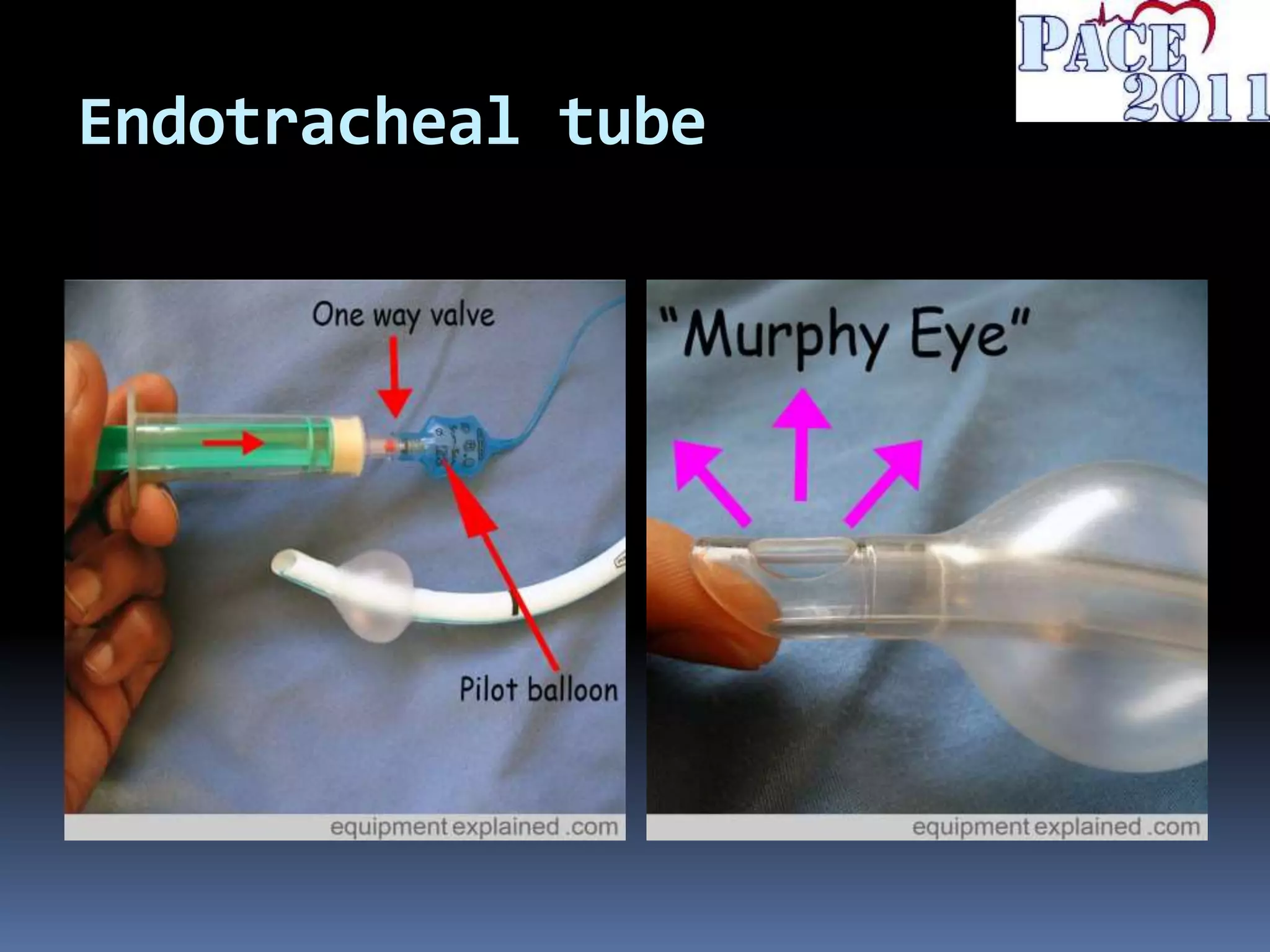 Endotracheal tube
 