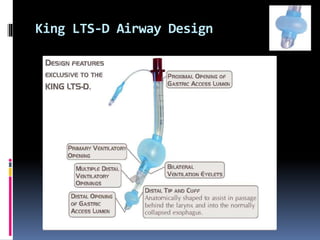 King LTS-D Airway Design
 