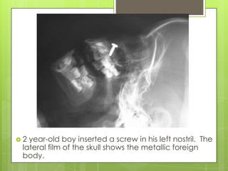 2

year-old boy inserted a screw in his left nostril. The
lateral film of the skull shows the metallic foreign
body.

 