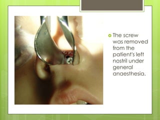  The

screw
was removed
from the
patient's left
nostril under
general
anaesthesia.

 
