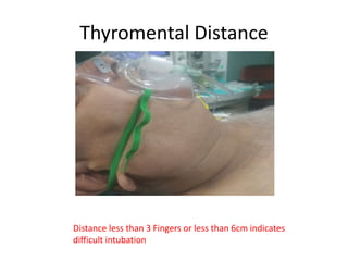 Airway inubation difficulties | PPTX