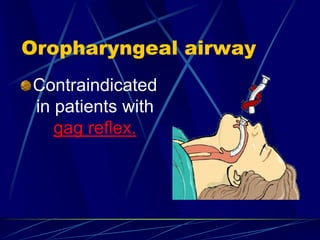 Oropharyngeal airway
Contraindicated
in patients with
gag reflex.
 