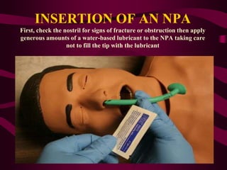 INSERTION OF AN NPA
First, check the nostril for signs of fracture or obstruction then apply
generous amounts of a water-based lubricant to the NPA taking care
not to fill the tip with the lubricant
 