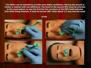 Two NPA's can be inserted to provide even better ventilation. Placing the second is
similar in fashion with one difference: The bevel of the second NPA must be oriented
to the nasal septum as was the first but the curvature of the NPA itself indicates
that while being inserted, it must be turned 180° when about 1/2 way into the nasal
cavity
 