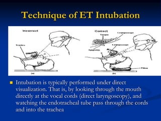 Technique of ET Intubation
 Intubation is typically performed under direct
visualization. That is, by looking through the mouth
directly at the vocal cords (direct laryngoscopy), and
watching the endotracheal tube pass through the cords
and into the trachea
 