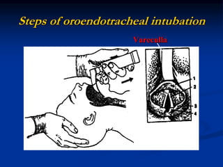 Steps of oroendotracheal intubation
Vareculla
 