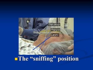 The “sniffing” position
 