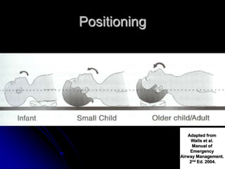 Positioning
Adapted from
Walls et al.
Manual of
Emergency
Airway Management.
2nd Ed. 2004.
 