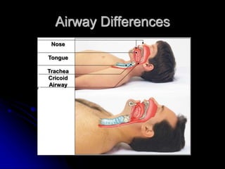 Airway Differences
Nose
Tongue
Trachea
Cricoid
Airway
 
