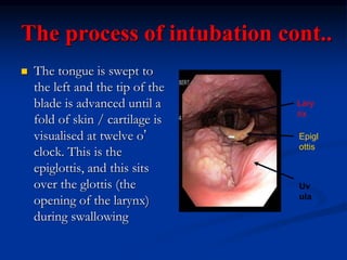 The process of intubation cont..
 The tongue is swept to
the left and the tip of the
blade is advanced until a
fold of skin / cartilage is
visualised at twelve o’
clock. This is the
epiglottis, and this sits
over the glottis (the
opening of the larynx)
during swallowing
Uv
ula
Epigl
ottis
Lary
nx
 