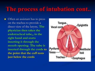 The process of intubation cont..
 Often an assistant has to press
on the trachea to provide a
direct view of the larynx. The
physician then takes the
endotracheal tube,, in the
right hand and starts
inserting it through the
mouth opening. The tube is
inserted through the cords to
the point that the cuff rests
just below the cords
 