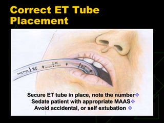 Correct ET Tube
Placement
Secure ET tube in place, note the number
Sedate patient with appropriate MAAS
Avoid accidental, or self extubation
 