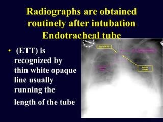 Radiographs are obtained
routinely after intubation
Endotracheal tube
• (ETT) is
recognized by
thin white opaque
line usually
running the
length of the tube
 