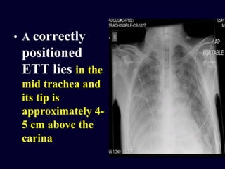 • A correctly
positioned
ETT lies in the
mid trachea and
its tip is
approximately 4-
5 cm above the
carina
 