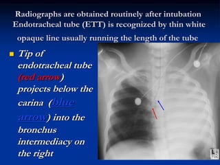 Radiographs are obtained routinely after intubation
Endotracheal tube (ETT) is recognized by thin white
opaque line usually running the length of the tube
 Tip of
endotracheal tube
(red arrow)
projects below the
carina (blue
arrow) into the
bronchus
intermediacy on
the right
 