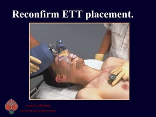 Reconfirm ETT placement.
‫السعودية‬ ‫القلب‬ ‫جمعية‬
SAUDI HEART ASSOCIATION
 