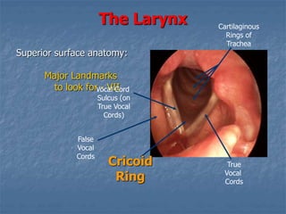 The Larynx
Superior surface anatomy:
Major Landmarks
to look for - VII
Cartilaginous
Rings of
Trachea
True
Vocal
Cords
Vocal Cord
Sulcus (on
True Vocal
Cords)
Cricoid
Ring
False
Vocal
Cords
 