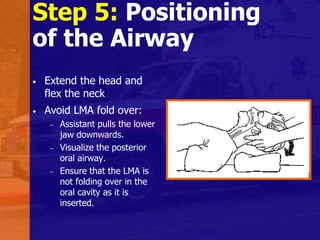 Step 5: Positioning
of the Airway
• Extend the head and
flex the neck
• Avoid LMA fold over:
– Assistant pulls the lower
jaw downwards.
– Visualize the posterior
oral airway.
– Ensure that the LMA is
not folding over in the
oral cavity as it is
inserted.
 