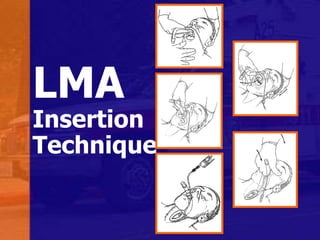 LMA
Insertion
Technique
 
