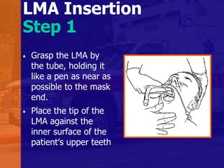 LMA Insertion
Step 1
• Grasp the LMA by
the tube, holding it
like a pen as near as
possible to the mask
end.
• Place the tip of the
LMA against the
inner surface of the
patient’s upper teeth
 