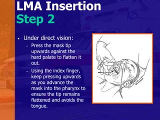 LMA Insertion
Step 2
• Under direct vision:
– Press the mask tip
upwards against the
hard palate to flatten it
out.
– Using the index finger,
keep pressing upwards
as you advance the
mask into the pharynx to
ensure the tip remains
flattened and avoids the
tongue.
 