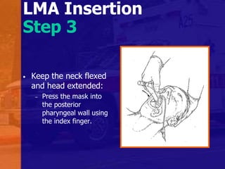 LMA Insertion
Step 3
• Keep the neck flexed
and head extended:
– Press the mask into
the posterior
pharyngeal wall using
the index finger.
 