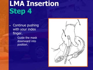 LMA Insertion
Step 4
• Continue pushing
with your index
finger.
– Guide the mask
downward into
position.
 