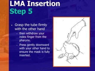 LMA Insertion
Step 5
• Grasp the tube firmly
with the other hand
– then withdraw your
index finger from the
pharynx.
– Press gently downward
with your other hand to
ensure the mask is fully
inserted.
 